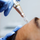 Microneedling Facial